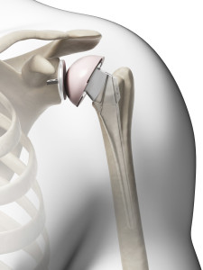 Total Shoulder Replacement in Berks County