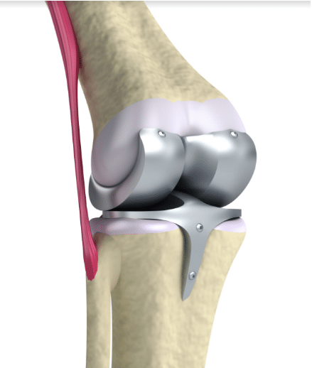 reasons for knee replacement surgery