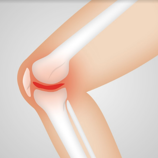 arthritis in the knee treatment options